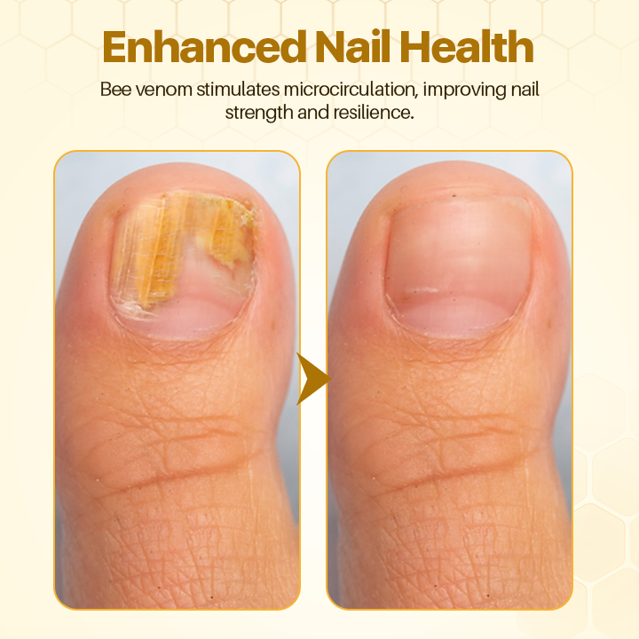 BeeVenom Nail Restoration Serum (BUY 1 GET 1 FREE + COD)
