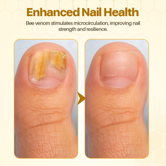 BeeVenom Nail Restoration Serum (BUY 1 GET 1 FREE + COD)
